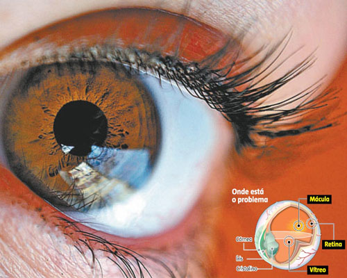 Diabetes provoca 80% das doenças da retina em pacientes de hospital estadual