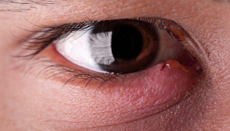 Dia da Saúde Ocular: oito dicas para evitar alergias e infecções nos olhos  